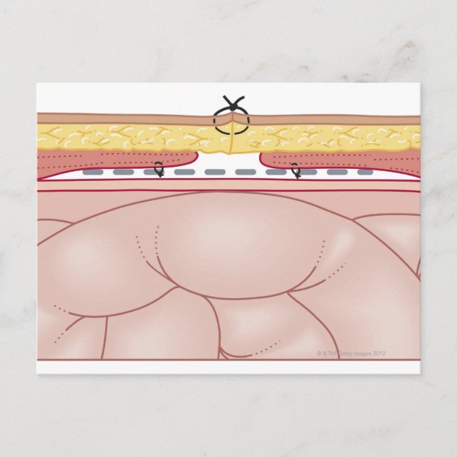 Darstellung einer Hernie Postkarte (Vorderseite)