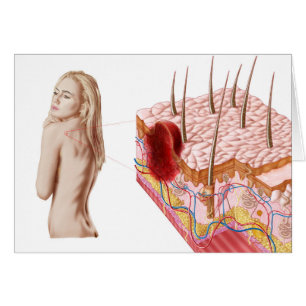 Darstellung eines atypischen Hautwachstums
