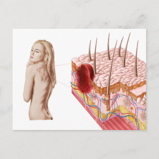 Darstellung eines atypischen Hautwachstums Postkarte