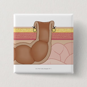 Dauerhafter Colostomy Button