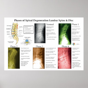 Degeneration der Lendenwirbelsäule Chiropraktik Poster