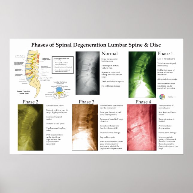 Degeneration der Lendenwirbelsäule Chiropraktik Poster (Vorne)