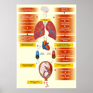 Diagramm eines amniotischen Flüssigkeitsembolismus Poster