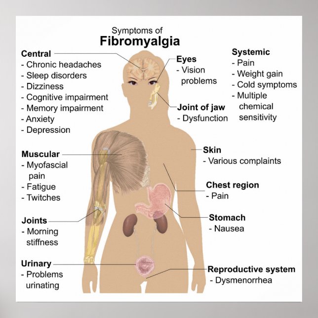 Diagramm Gemeinsame Anzeichen + Symptome Fibromyal Poster (Vorne)