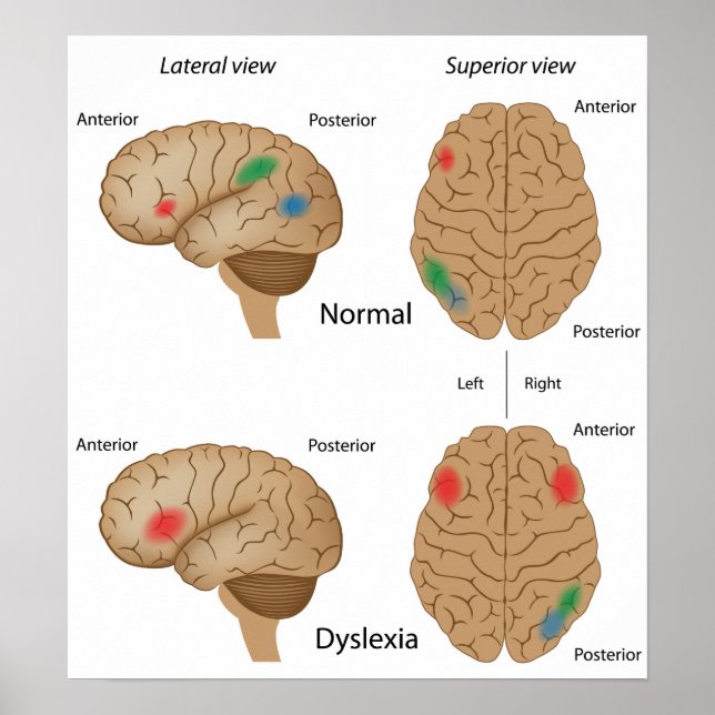 Dyslexie Gehirnaktivität Poster (Vorne)