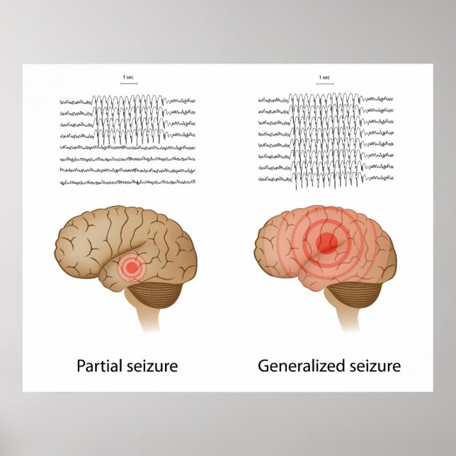 EEG bei partieller und genereller Epilepsie Poster (Vorne)