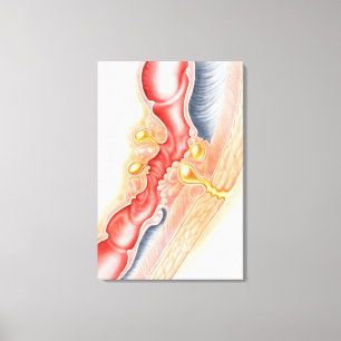 Entwicklung der Fistel Leinwanddruck