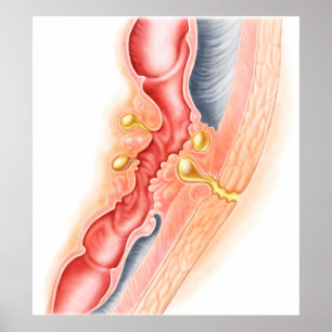 Entwicklung der Fistula Poster