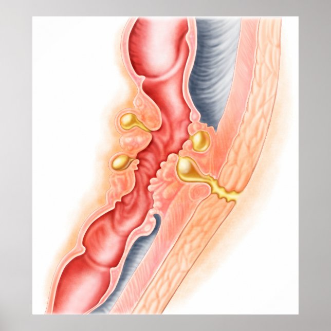 Entwicklung der Fistula Poster (Vorne)