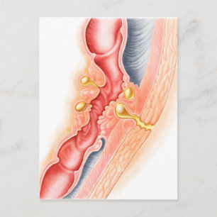 Entwicklung der Fistula Postkarte