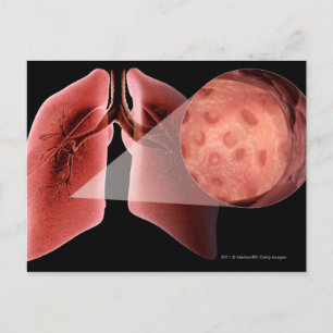 Entzündete Atemwege während eines Asthmaanfalls Postkarte