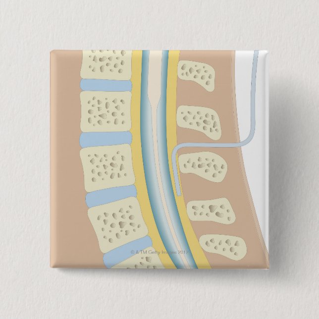 Epidurale Anästhesie Button (Vorderseite)