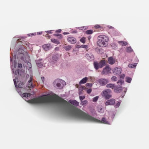 Epithelioid uveal melanoma krawatte