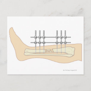 Externer Fixator Postkarte