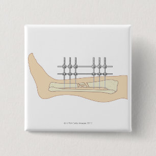 Externes Fixator Button