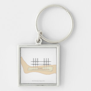 Externes Fixator Schlüsselanhänger