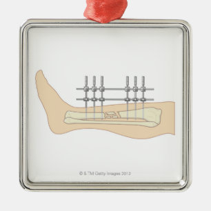 Externes Fixator Silbernes Ornament