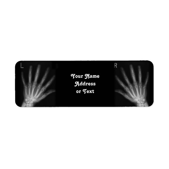 Extra-Digit-Röntgen-rechte und Links Hände (Vorne)