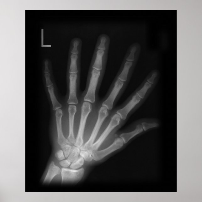 Extra Digit X-ray Left Hand Poster (Vorne)