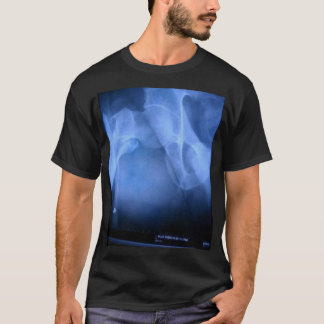 gebrochenes Schenkelbein T-Shirt