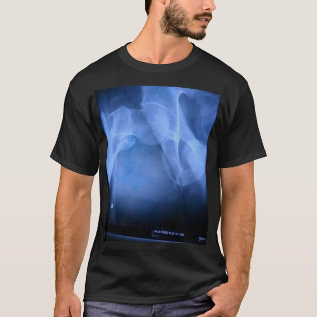 gebrochenes Schenkelbein T-Shirt (Vorderseite)