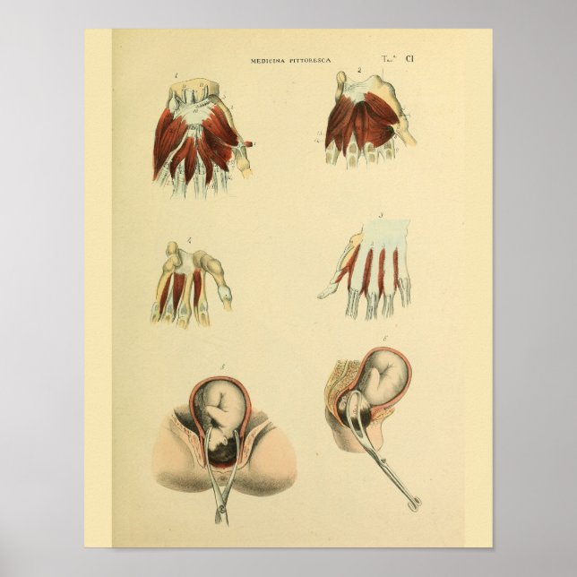 Geburtsforceps Obstetrics Anatomie Medizin Art Pri Poster (Vorne)