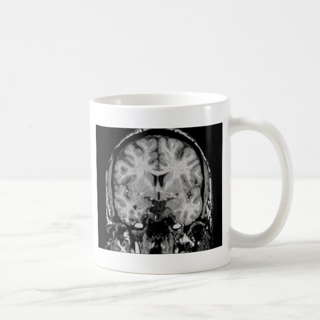 Gehirn MRI, Kranzscheibe Kaffeetasse (Rechts)