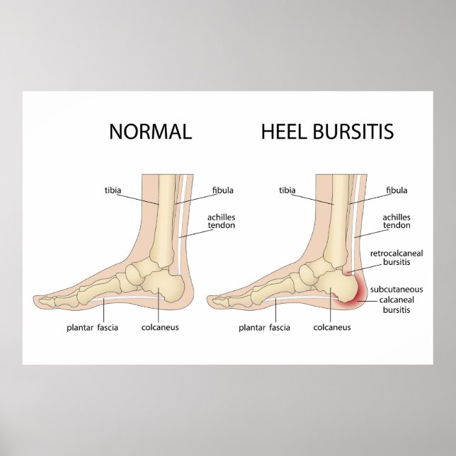Haglund-Deformität Poster (Vorne)