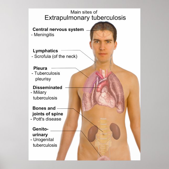 Hauptsymptome der extrapulmonalen Tuberkulose Poster (Vorne)