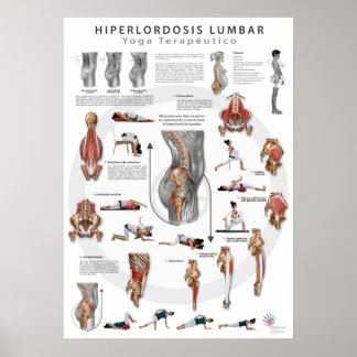 Hiperlordosis - Definition, Ursachen und Poster