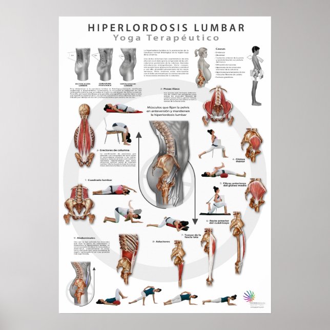 Hiperlordosis - Definition, Ursachen und Poster (Vorne)