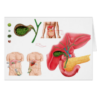 Illustration der Cholektomie