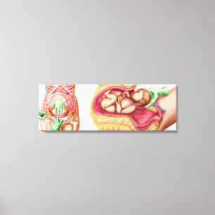 Illustration, die Caesarean Lieferung des Fötusses Leinwanddruck