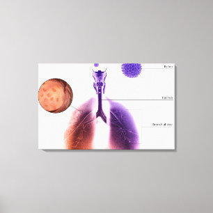 Illustration eines Asthmaanfalls von Pollen Leinwanddruck