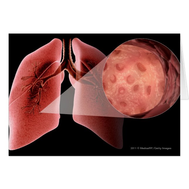 Inflammed Fluglinie während eines Asthmaanfalls (Vorderseite (Horizontal))
