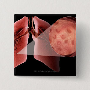 Inflammed Fluglinie während eines Asthmaanfalls Button