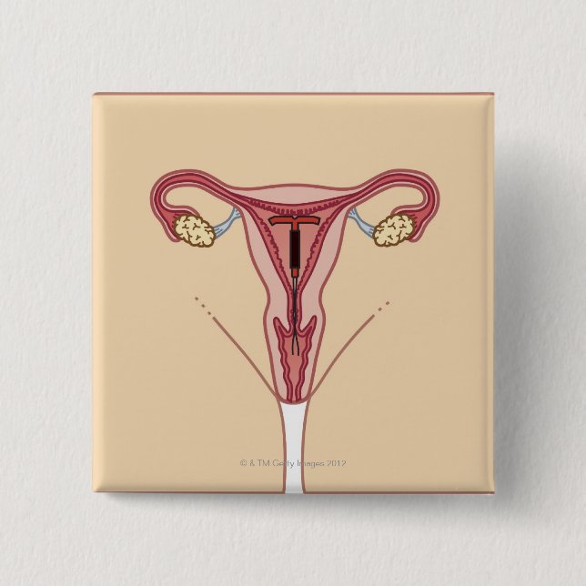 Intrauterinjektor Button (Vorderseite)