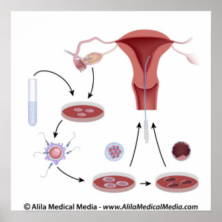 IVF-Verfahren ohne Beschriftung Poster