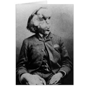 Joseph "John" Merrick Der Elefantenmann von 1889