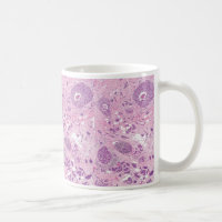 Kaffee Tasse-Brust Krebs-Zellen