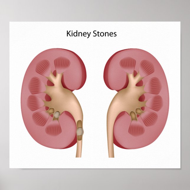 Kidney Stone Poster (Vorne)