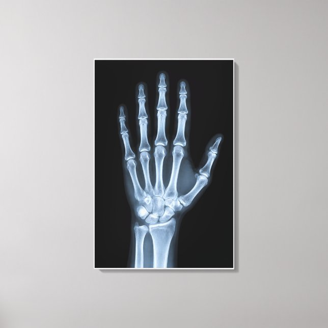 Klinisches Röntgenbild der Hand Leinwanddruck (Vorderseite)