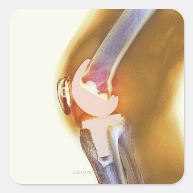 Kniegelenksersatz. Farbige Röntgenaufnahme eines g Quadratischer Aufkleber (Vorderseite)