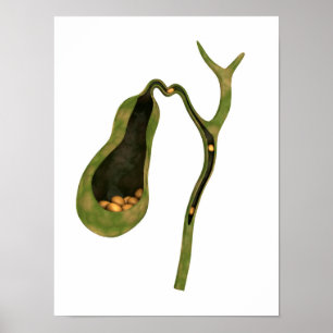 Konzeptbild von Gallstones im Gall Poster