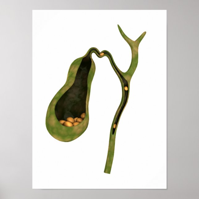 Konzeptbild von Gallstones im Gall Poster (Vorne)