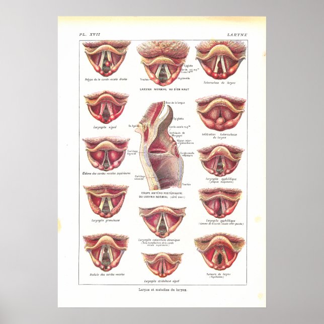 Krankheiten des Larynx Anatomy Poster Französisch (Vorne)
