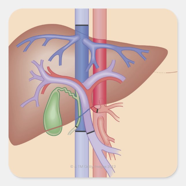 Lebertransplantation Quadratischer Aufkleber (Vorderseite)