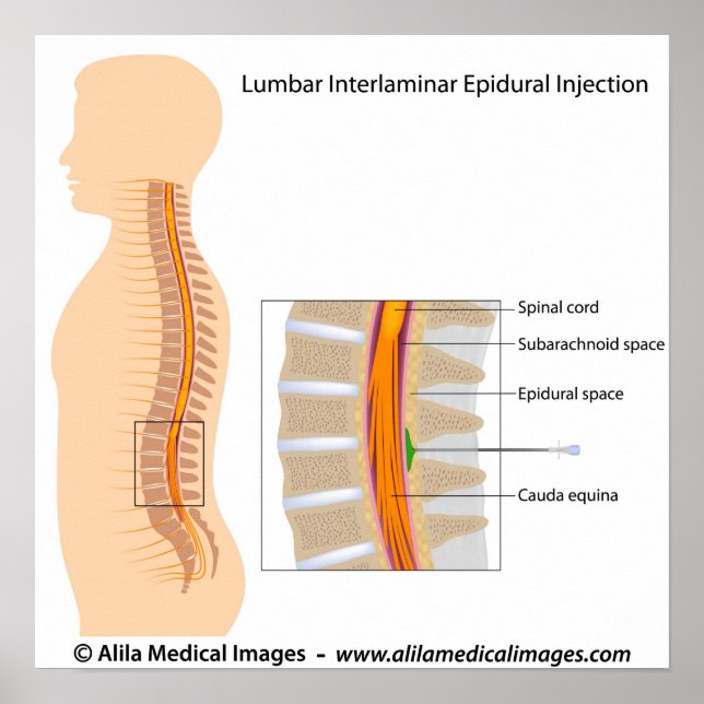 Lumbar epidurale Injektion, beschriftet. Poster (Vorne)