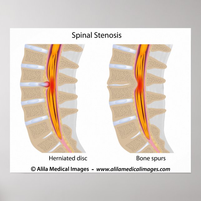 Lumbar Spinale Stenosis, medizinisches zeichn. Poster (Vorne)
