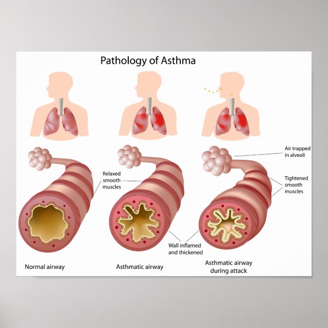 Lungenerkrankung Asthma Poster (Vorne)